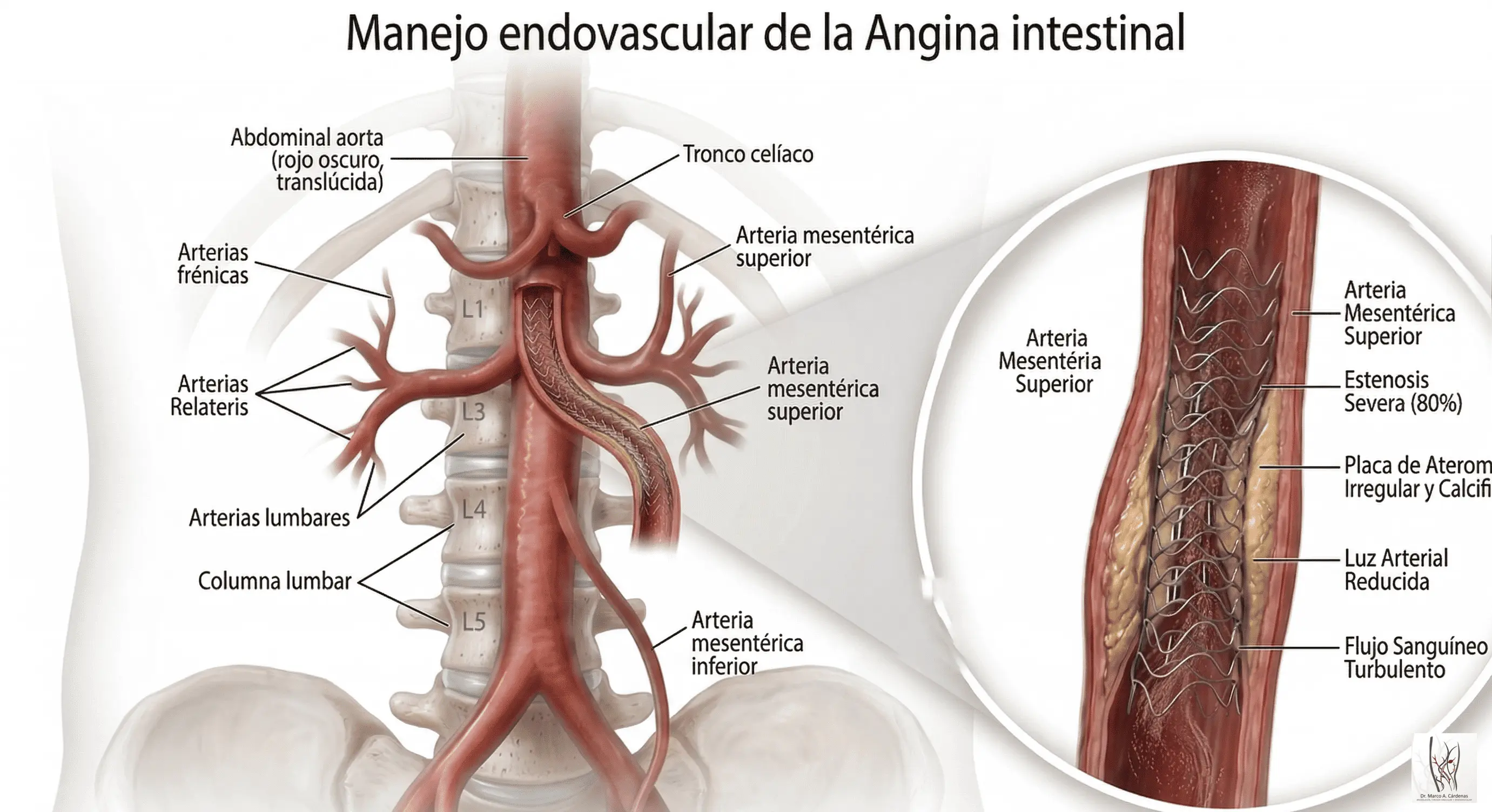 Angina Intestinal